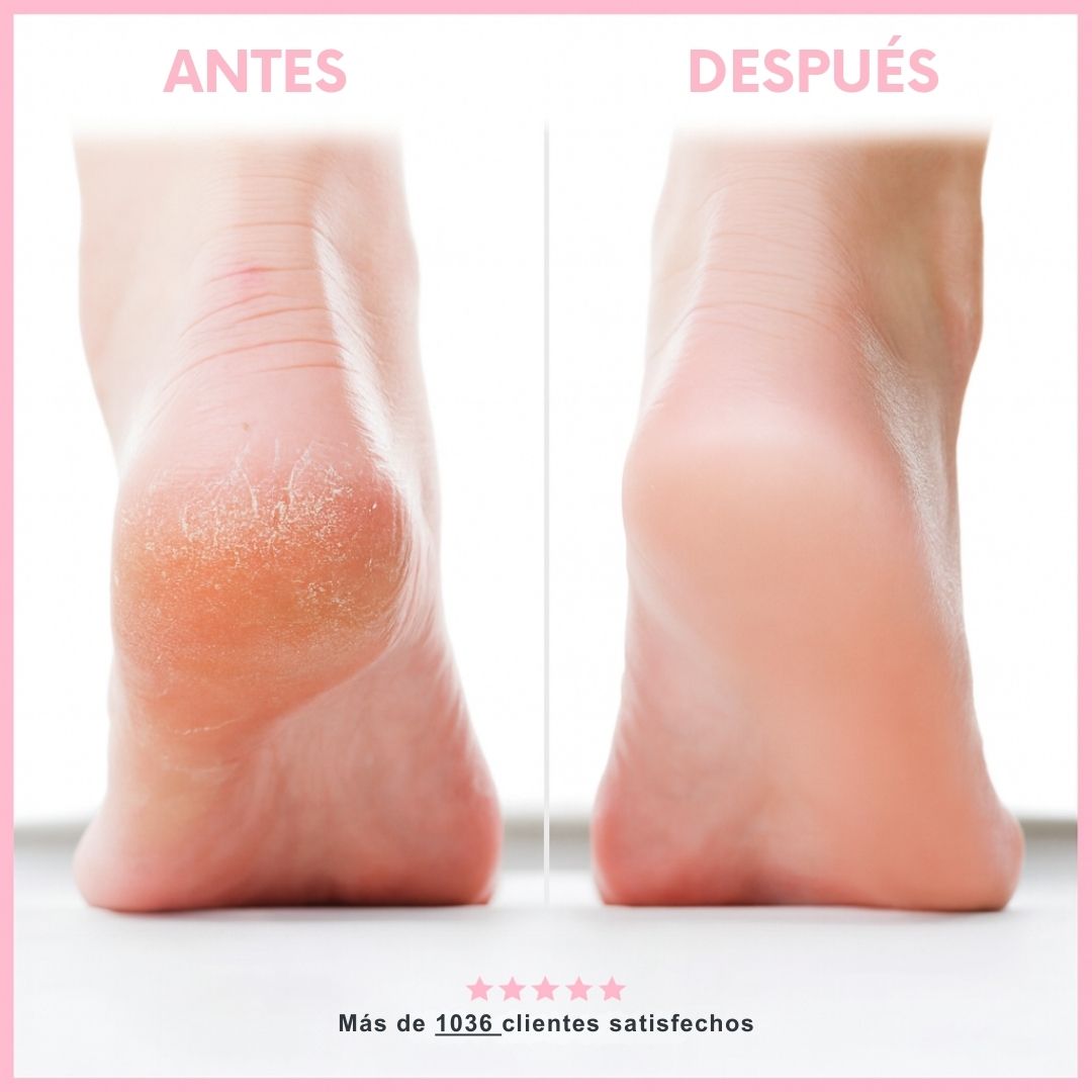 Eliminador de callos eléctrico Blovanda Glow - Hipnotelia